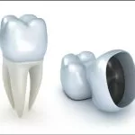 tooth repair-dublin