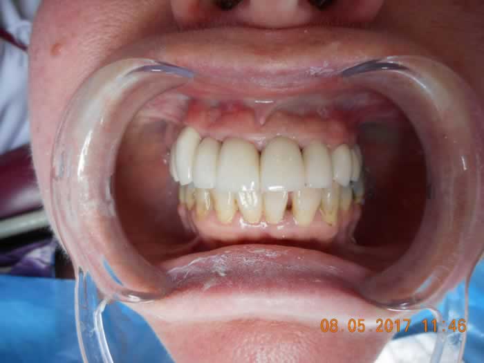 Porcelain fused to metal crowns - Case Study