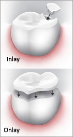 dental-inlays-dublin