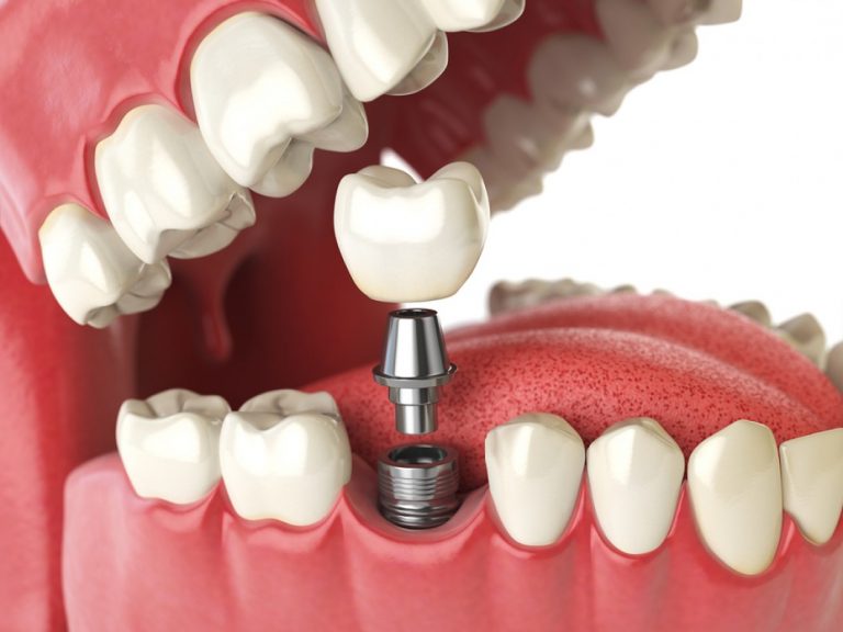 Dental Implants & Crown Dental
